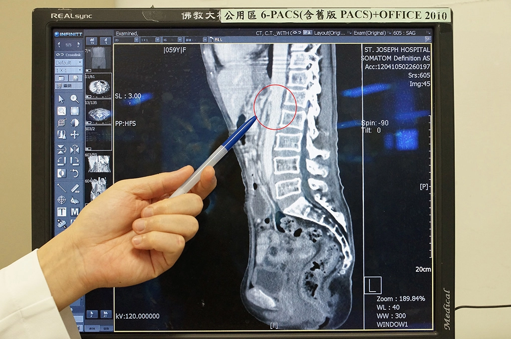 腹部電腦斷層檢查,醫師手指處為受到腹主動脈及上腸繫膜動脈擠壓的十二指腸位置。