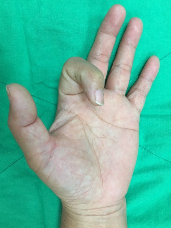 手指反覆做同一動作，易引起手指屈指肌腱狹窄性腱鞘炎。