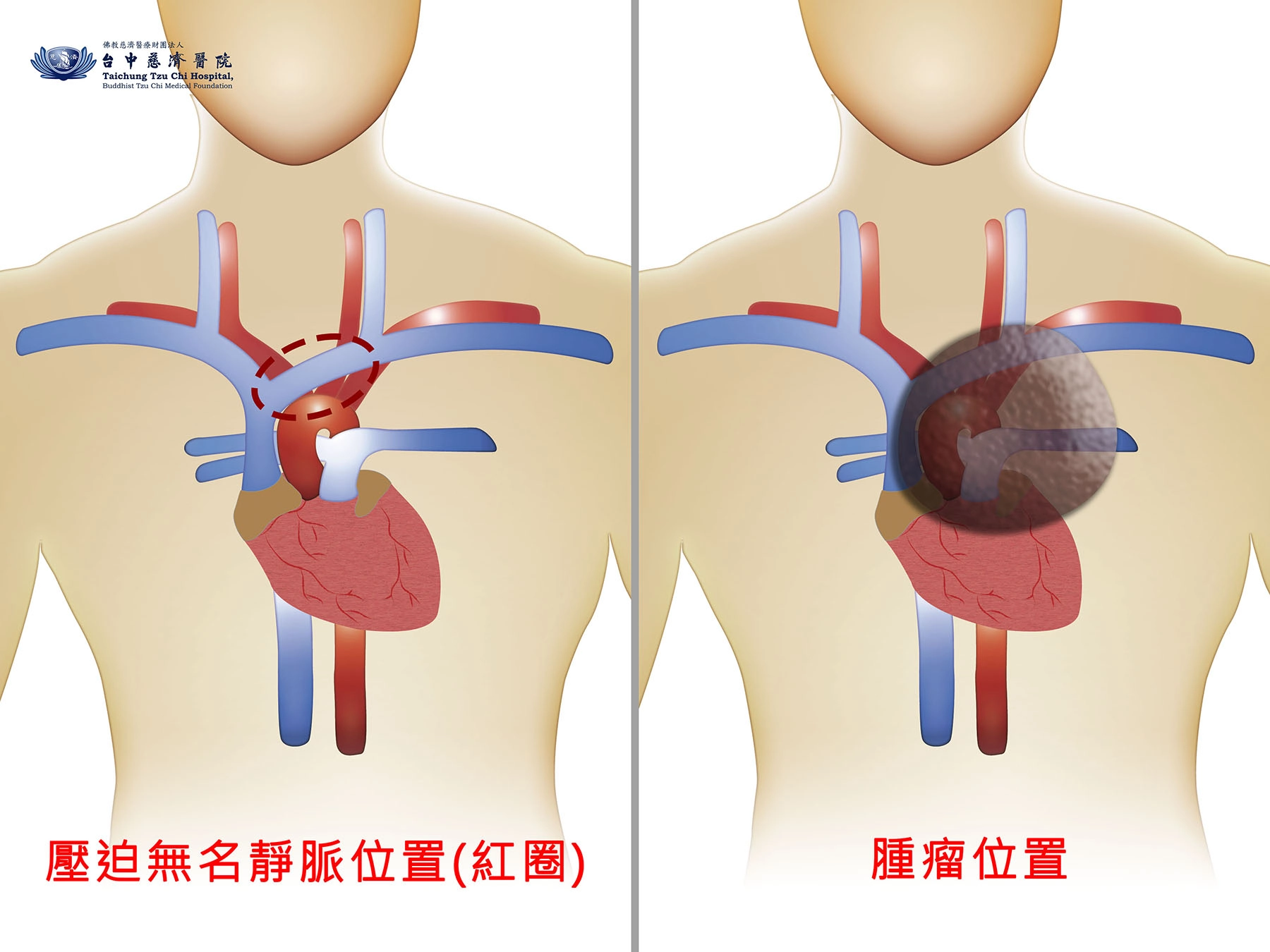 腫瘤壓迫無名靜脈位置示意圖