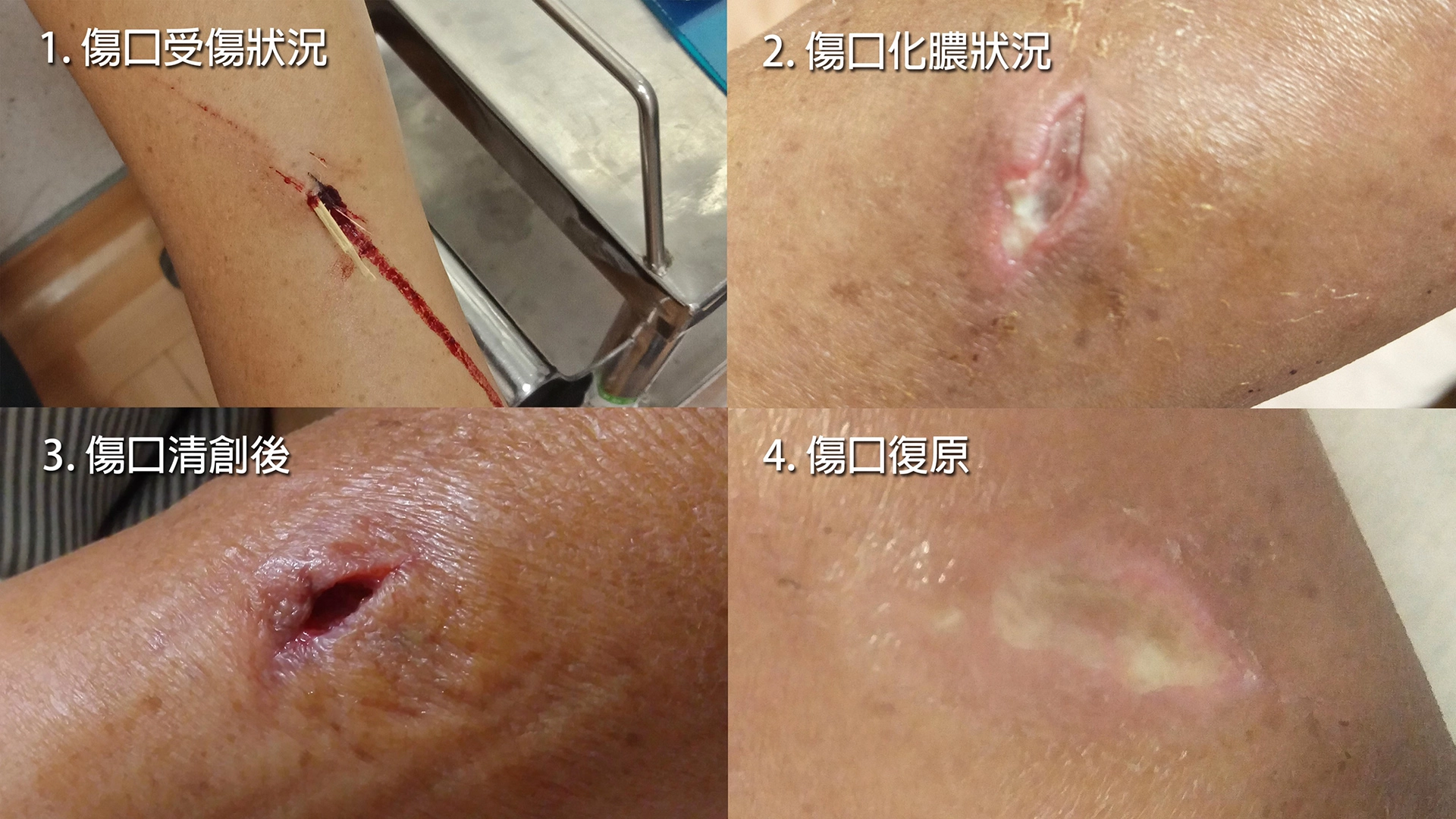 吳女士兩次住院接受抗生素治療的傷口變化狀況。(王瑞興醫師提供)
