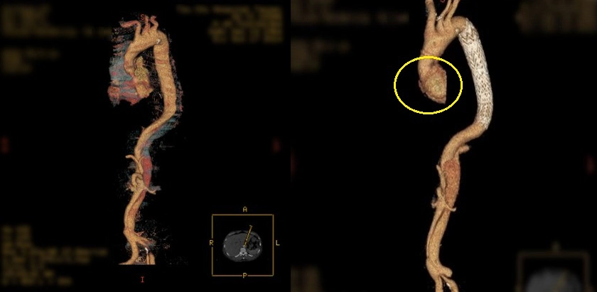 重組3D圖更可看出剝落情形嚴重（左圖）。第二次手術裝上胸主動脈覆膜支架，另還需處理主動脈根部瘤之問題(右圖)。