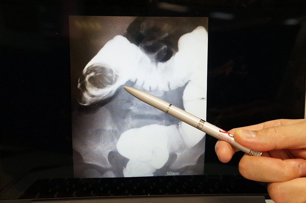 對於嬰幼兒腸套疊，為一種常見且父母及醫師都忽視不得的嬰幼兒腹部急症，由於不一定會出現典型症狀，加上孩子不會表達，因此在鑑別診斷上仍有一定難度。