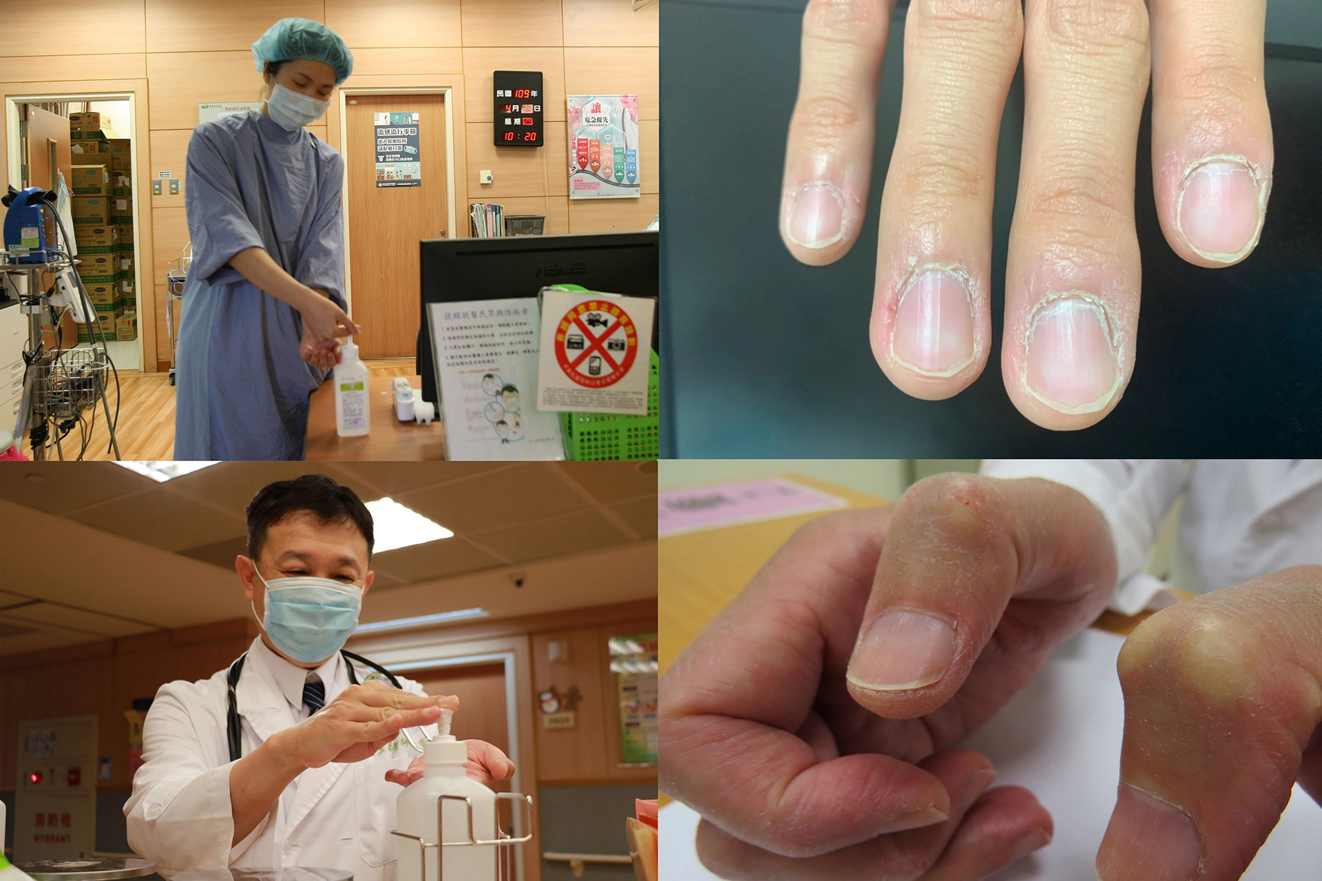 醫護人員接觸病人前、後，都須要用乾式洗手液清潔手部，皮膚已經出現龜裂、脫皮與傷口。