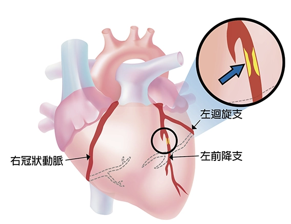 左圖：冠狀動脈粥狀血管硬化過程，1.正常動脈 2.形成動脈硬化血塊 3.被血塊阻塞的動脈 圖片出處：謝美玲、陳郁志等(2019冠狀動脈粥狀硬化心臟病之心導管檢查須知)P.4 右圖：冠狀動脈粥狀血管硬化，當冠狀動脈的血管壁裡面有不好的油(黃色處)堆積，而造成血管阻塞時，血管的血流量就會變小。 圖片出處：謝美玲、陳郁志等(2019冠狀動脈粥狀硬化心臟病之心導管檢查須知)P.5