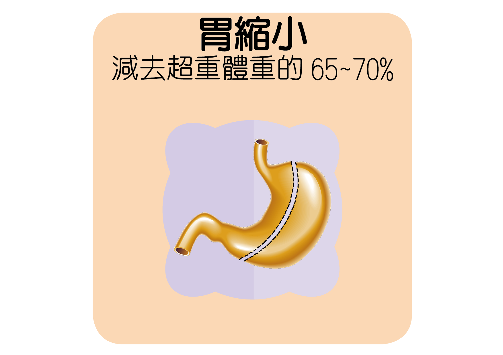 胃縮小手術減少胃容量、降低體重超重者食慾，帶動瘦身。（賴廷翰製圖）