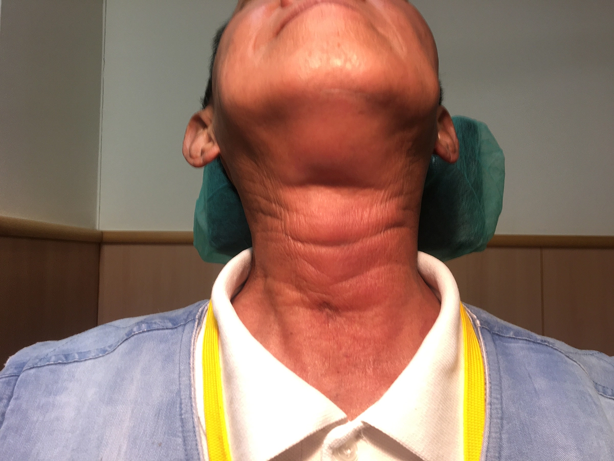 周一帆醫師指出黃先生治療前特大腫瘤已充滿喉部。