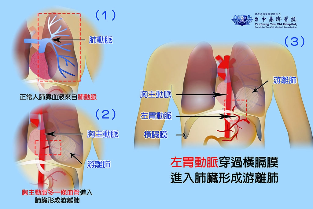 病人游離肺(3)示意圖。