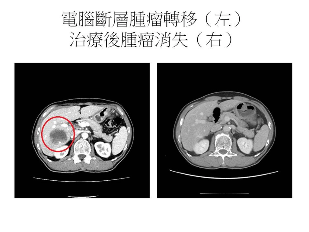 治療前與後電腦斷層對照。