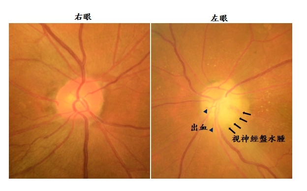 右眼是正常的眼睛 左邊是視神經小中風的造成的出血和水腫情形