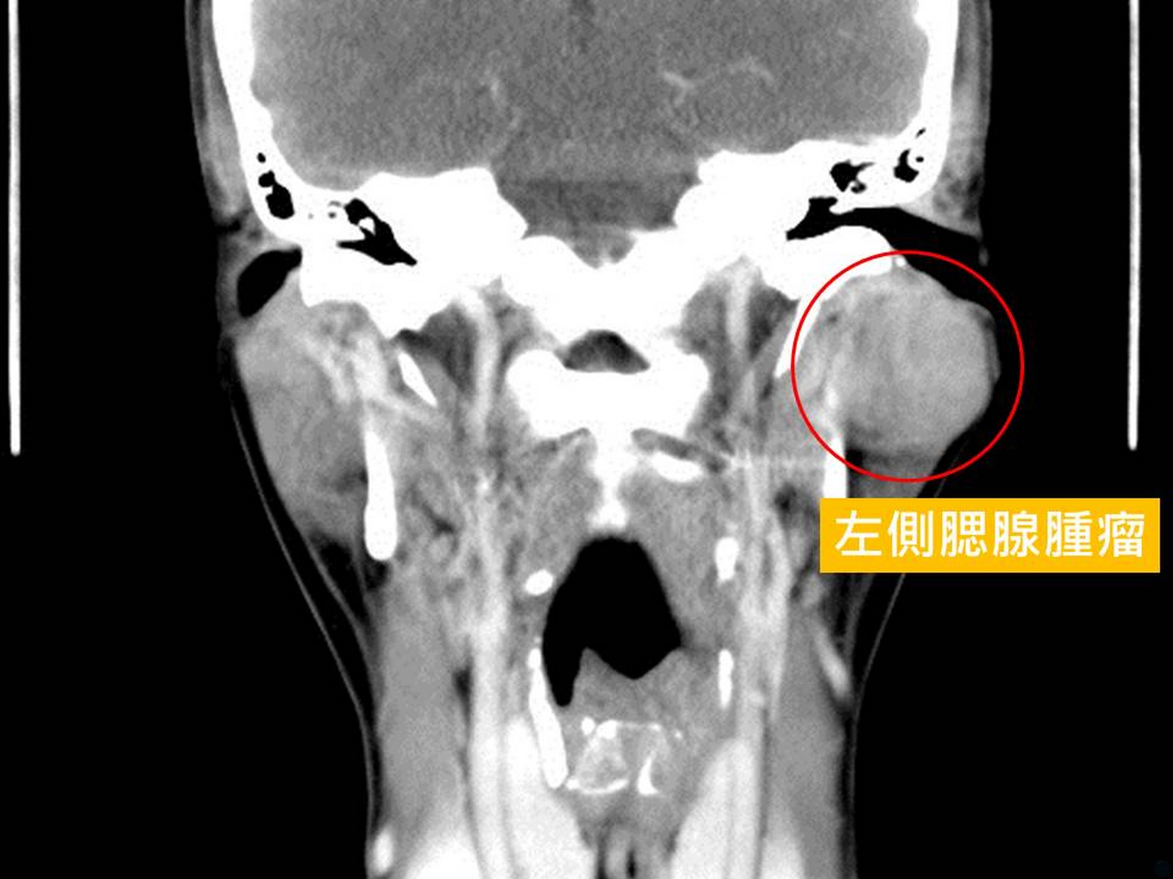 電腦斷層顯示腮腺腫瘤近4公分，像個包餡湯圓。