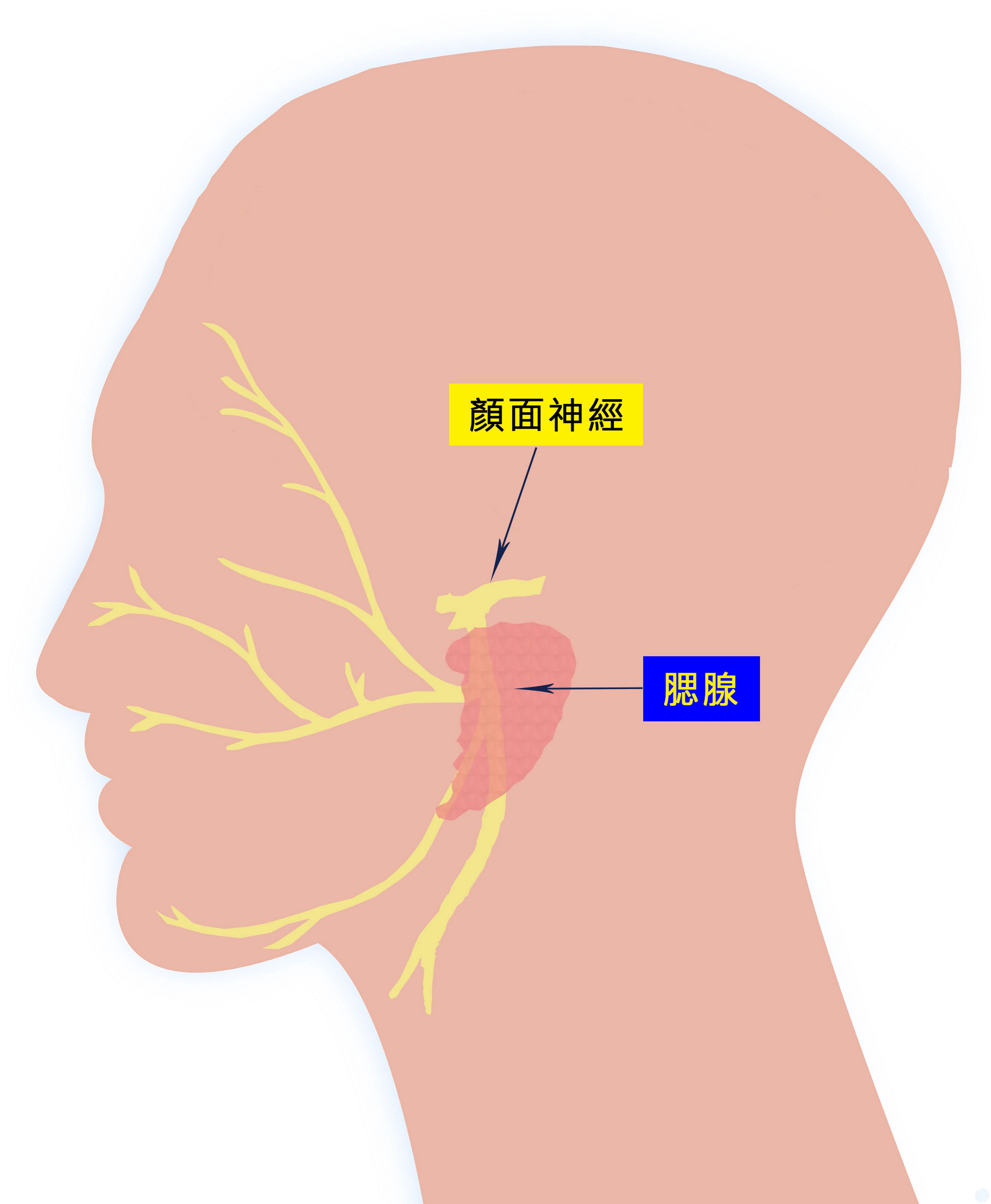 腮腺與顏面神經很接近，若拖延不處理導致腫瘤愈變愈大，會增加手術困難度與顏面神經損傷機率。