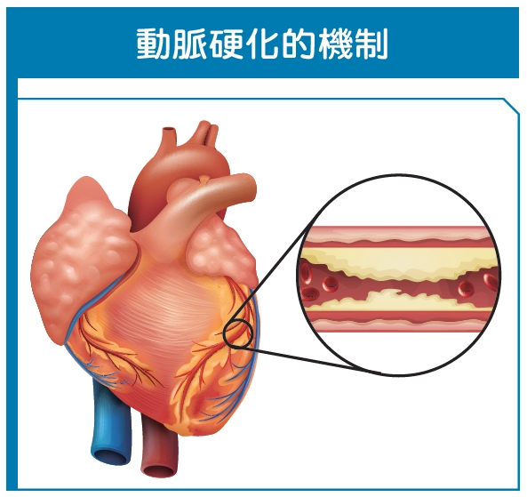 心臟的冠狀動脈，因抽菸、高血壓控制不佳、糖尿病、高血脂等情形，引起血管發炎，導致血管壁變硬，然後出現內壁的剝離，其後產生血栓，血管就會狹窄。