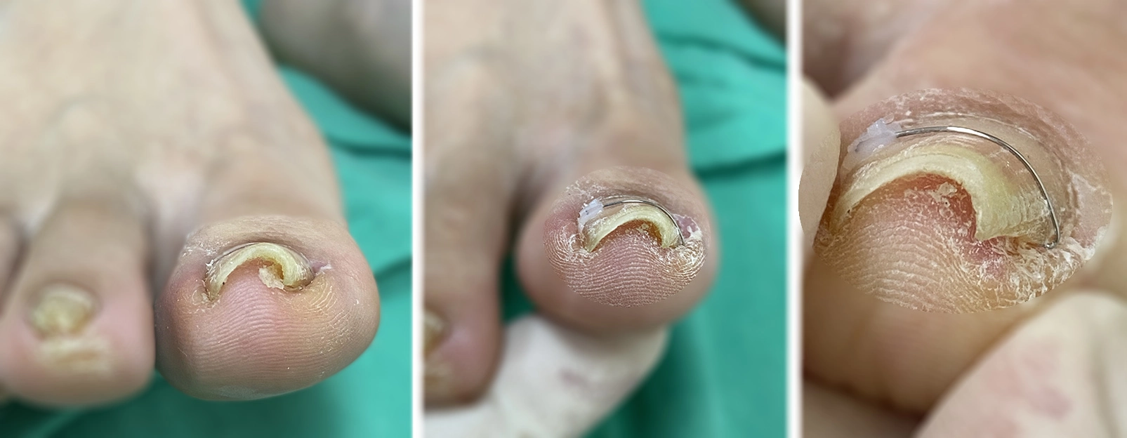 俗稱「凍甲」的嵌甲症，利用矯正器進行指甲矯正，不用開刀馬上就解決了