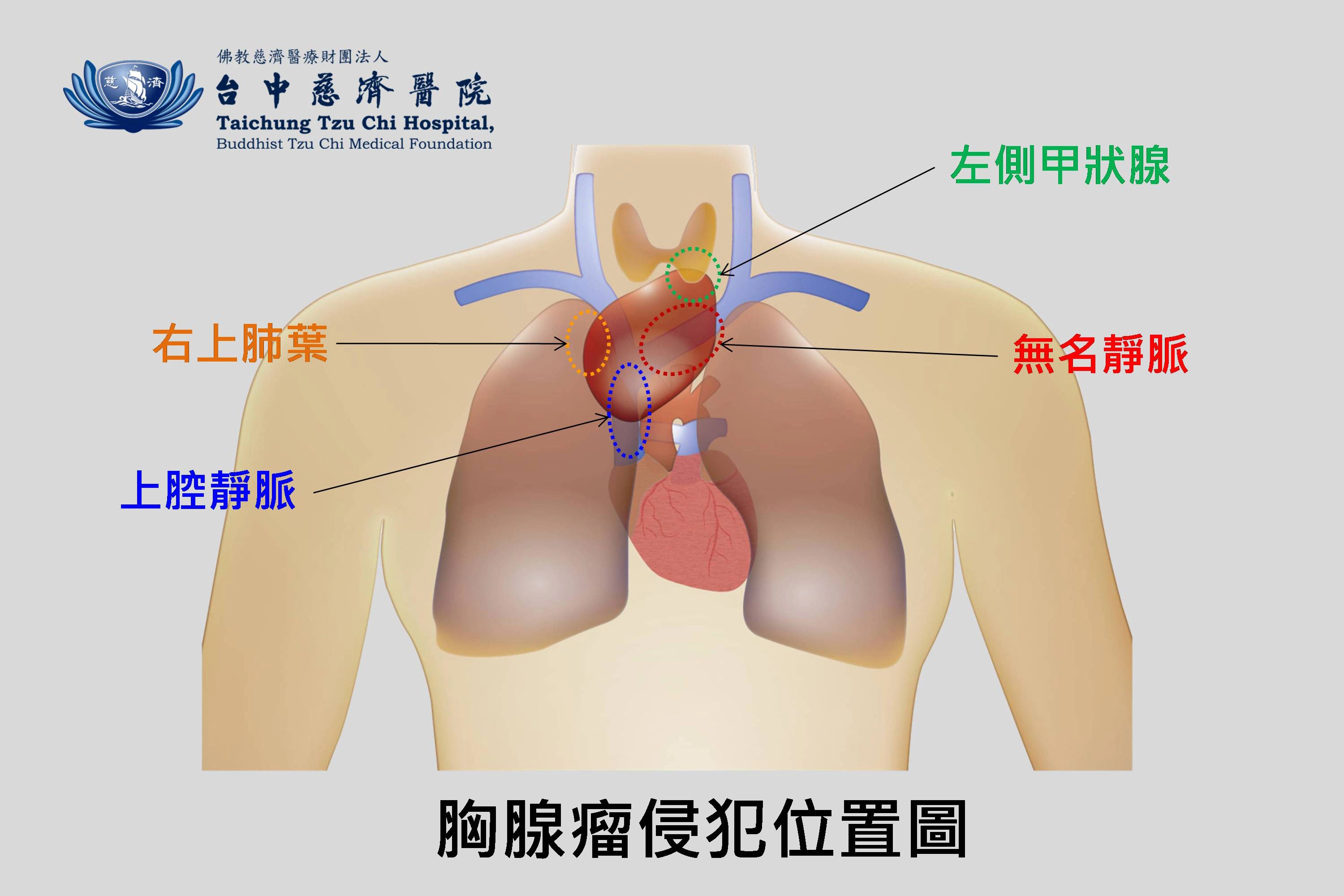 胸腺瘤侵犯位置示意圖。