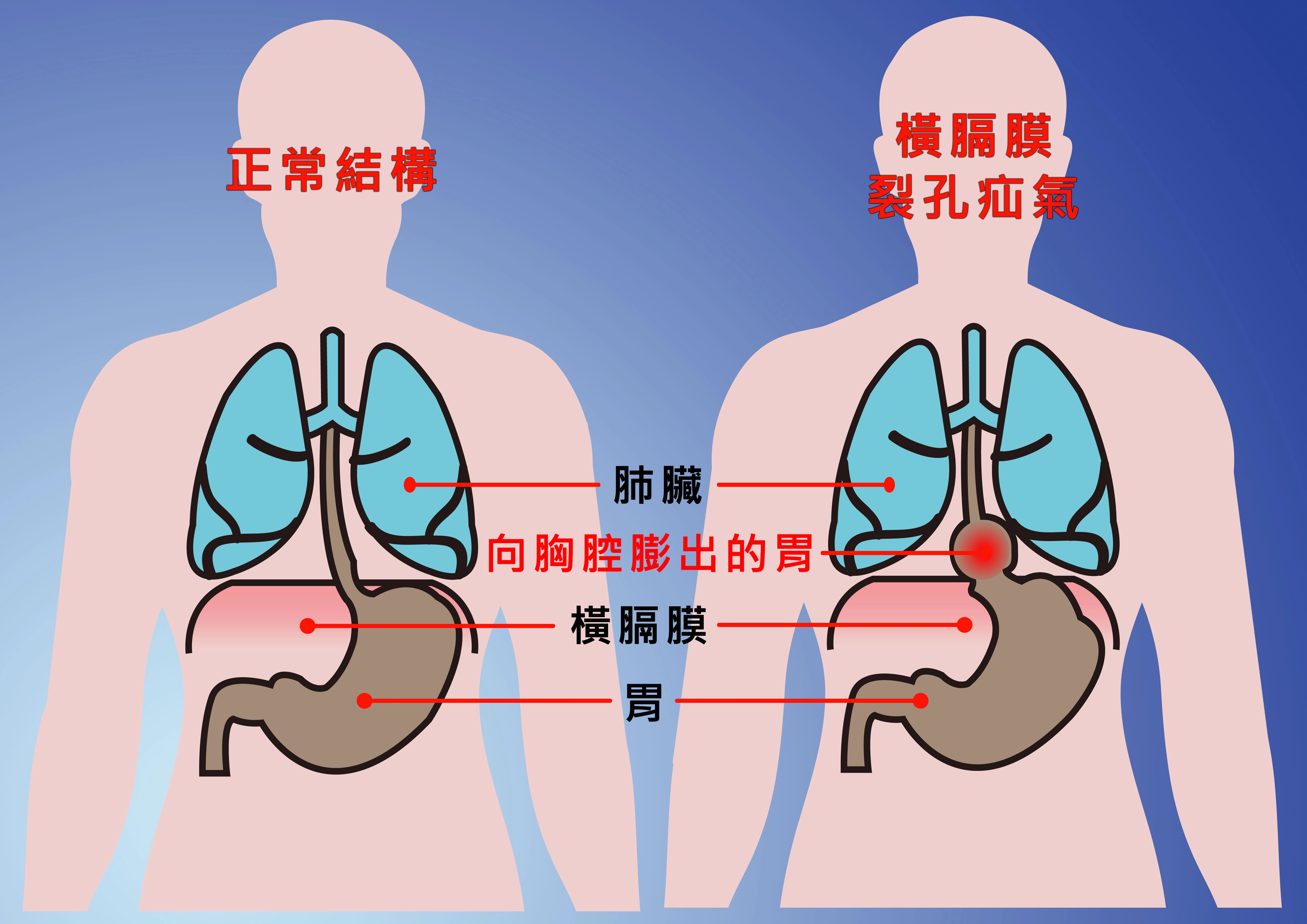 橫膈膜裂孔疝氣圖示。