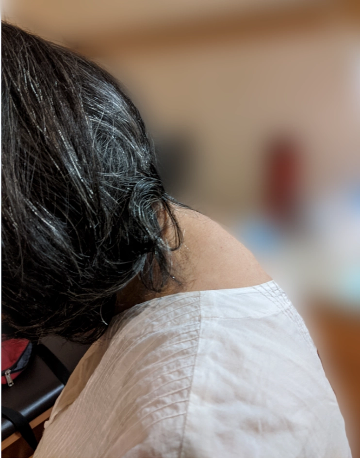 罹患庫欣氏症的張女士出現月亮臉、水牛肩等典型症狀。