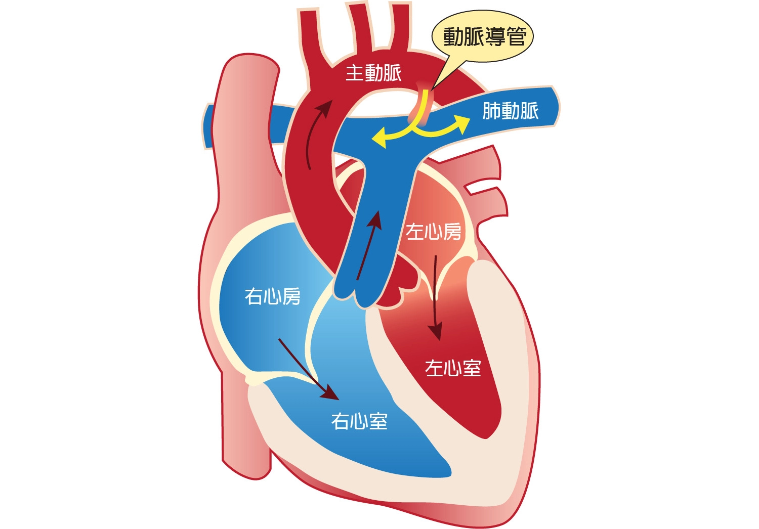主動脈與肺動脈之間相通的血管稱為動脈導管，一般在寶寶出生後二至三天會進行功能性閉鎖，開始了由肺部呼吸的肺循環，若未關閉，部份壓力較高的主動脈血液會流入肺動脈，加入肺循環而引起肺充血，稱為「開放性動脈導管」。