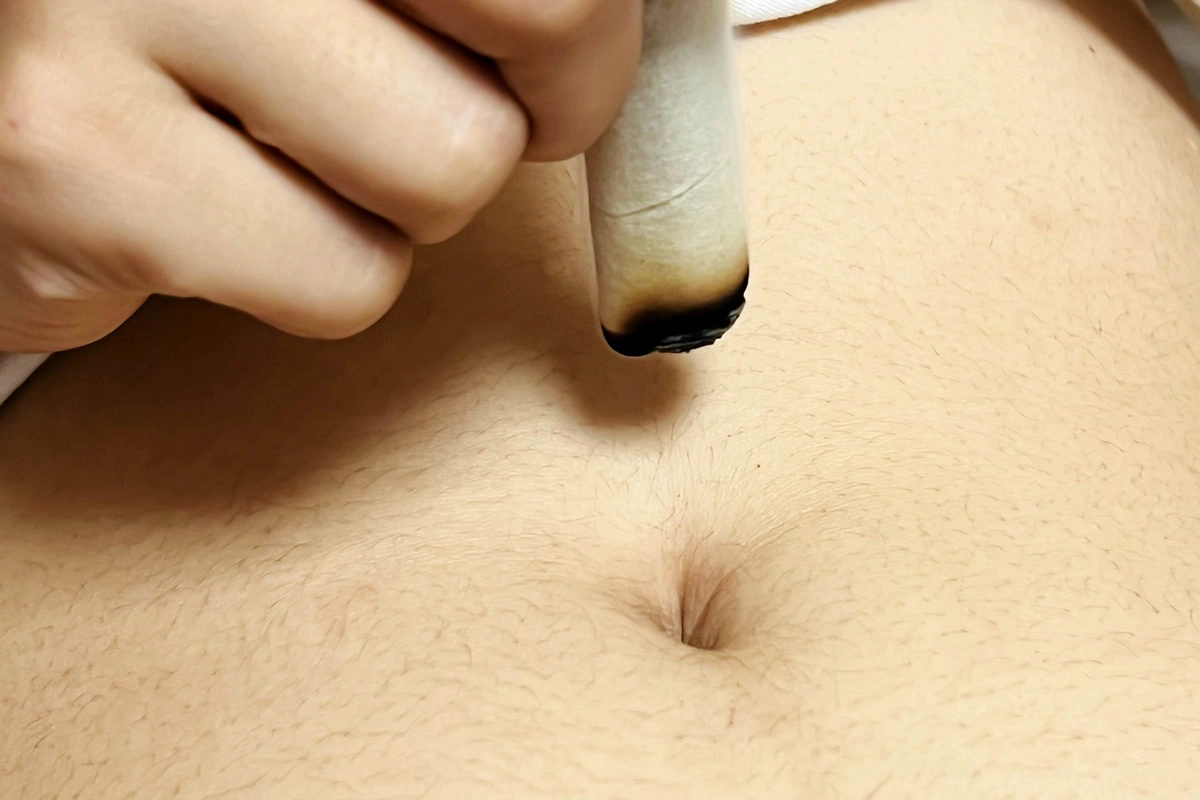 艾灸肚臍周圍特定穴位，配合醫師治療，溫女士病情控制穩定。圖為艾灸示意照。