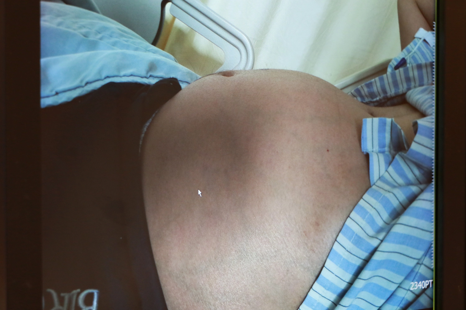 男子腹部巨大腫瘤如懷胎。