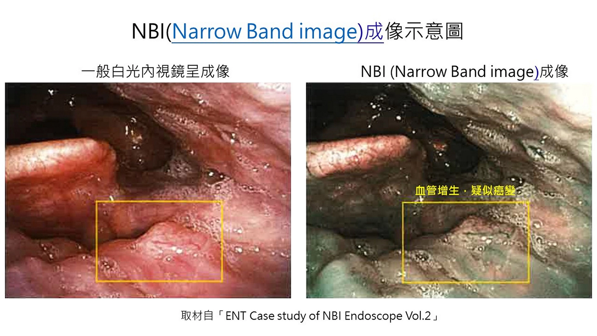 NBI成像示意圖。