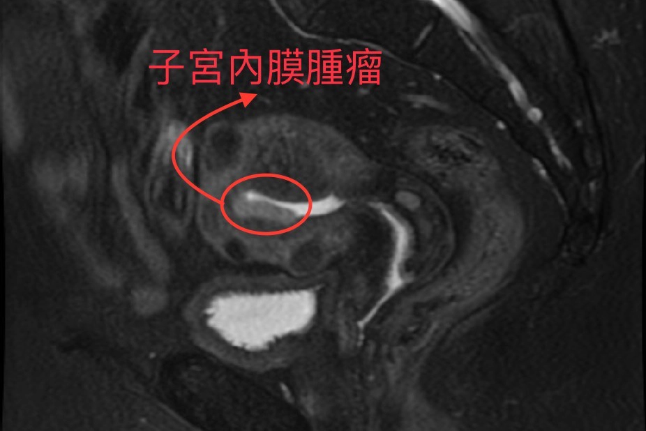子宮內膜腫瘤核磁共振造影(MRI)影像。