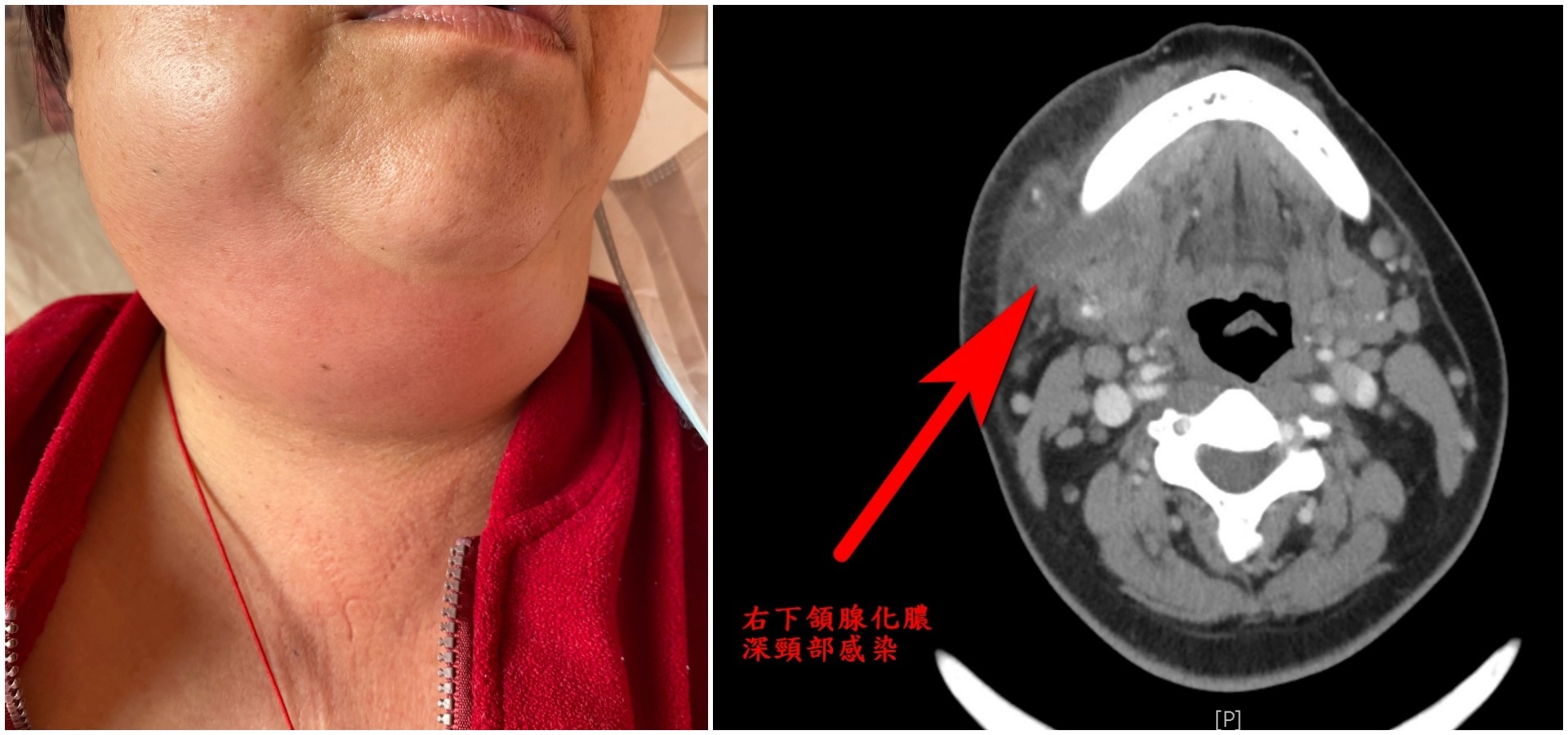 年近五旬鄭女士，拔牙後發燒、頸部腫痛，到花蓮慈濟醫院急診就醫，確診後為深頸部感染，致死率高達五成。（右圖）深頸部感染電腦斷層影像
