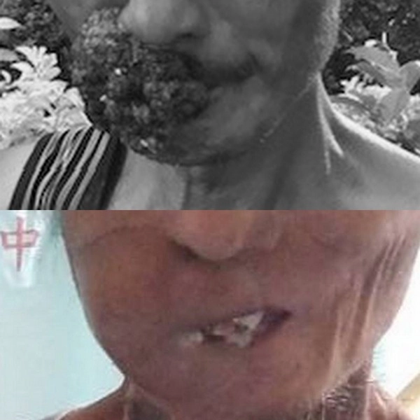 呂先生的惡性腫瘤擴及顏面及嘴唇(上)；魏林瑰醫師藉由「顯微游離皮瓣移植」為病人重建。