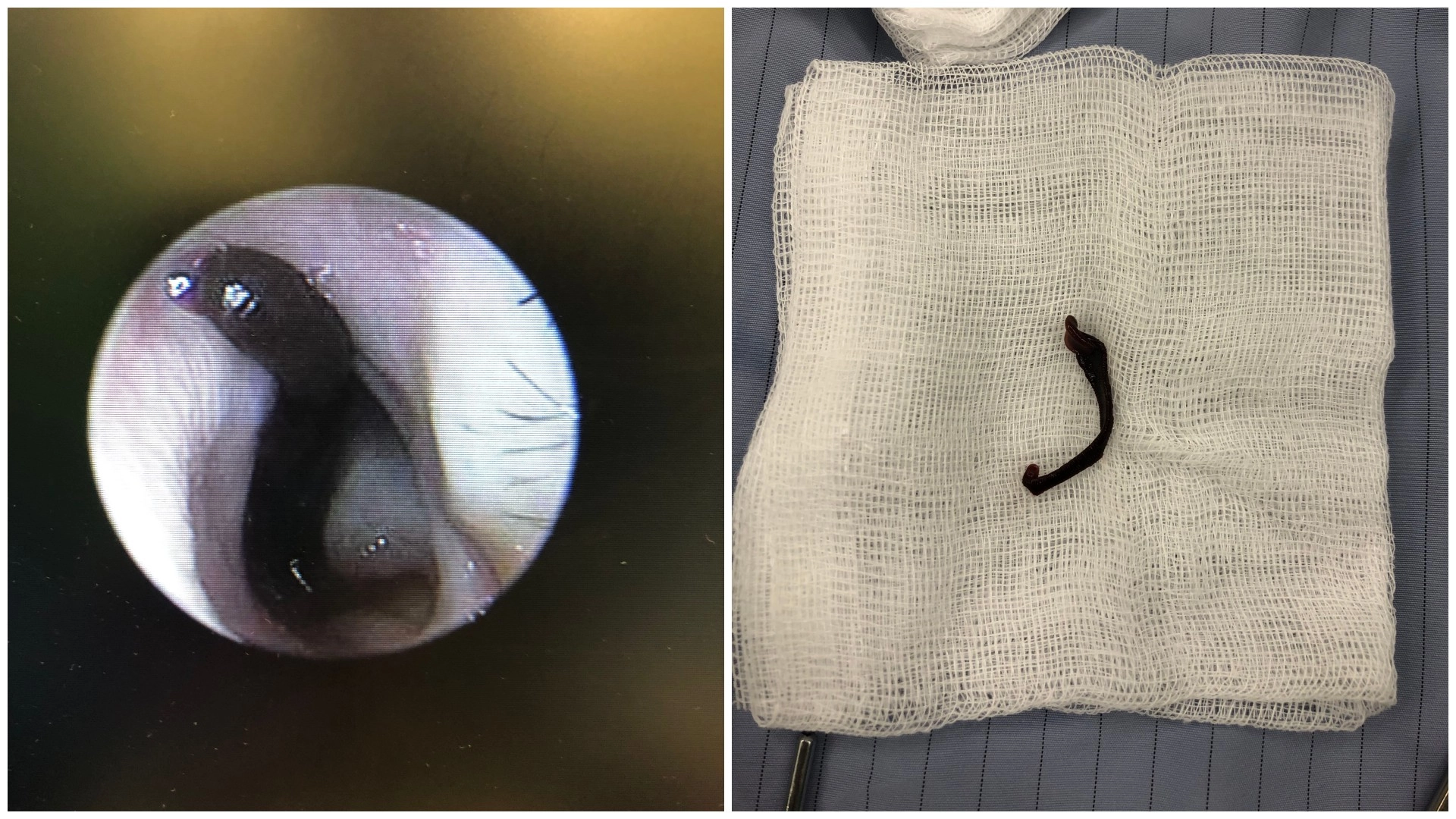 （左圖）2歲小女童送醫後，內視鏡看到的鼻蛭影像。（右圖）鼻蛭置於紗布上，逐漸失去活動力。