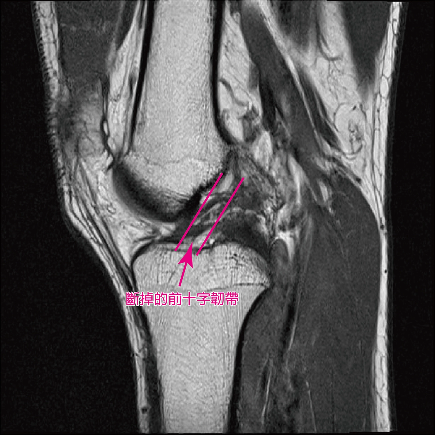 病人手術前前十字韌帶的磁振造影檢查(MRI) 影像。