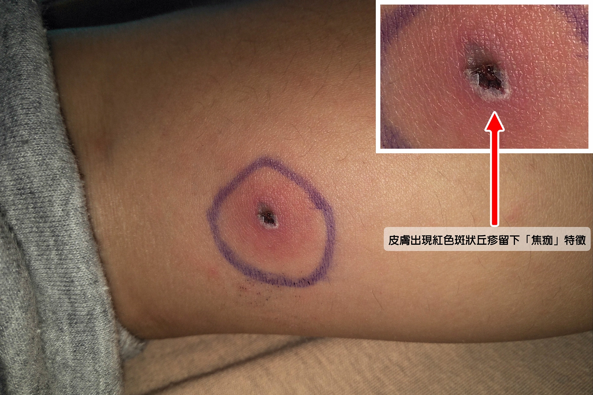 皮膚出現紅色斑狀丘疹留下「焦痂」特徵。（李宇正醫師提供）