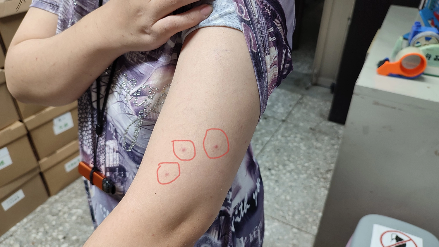 大多數蟎蟲生命期約3周內死亡。受害者呈三顆線狀或三角形排列的咬痕。