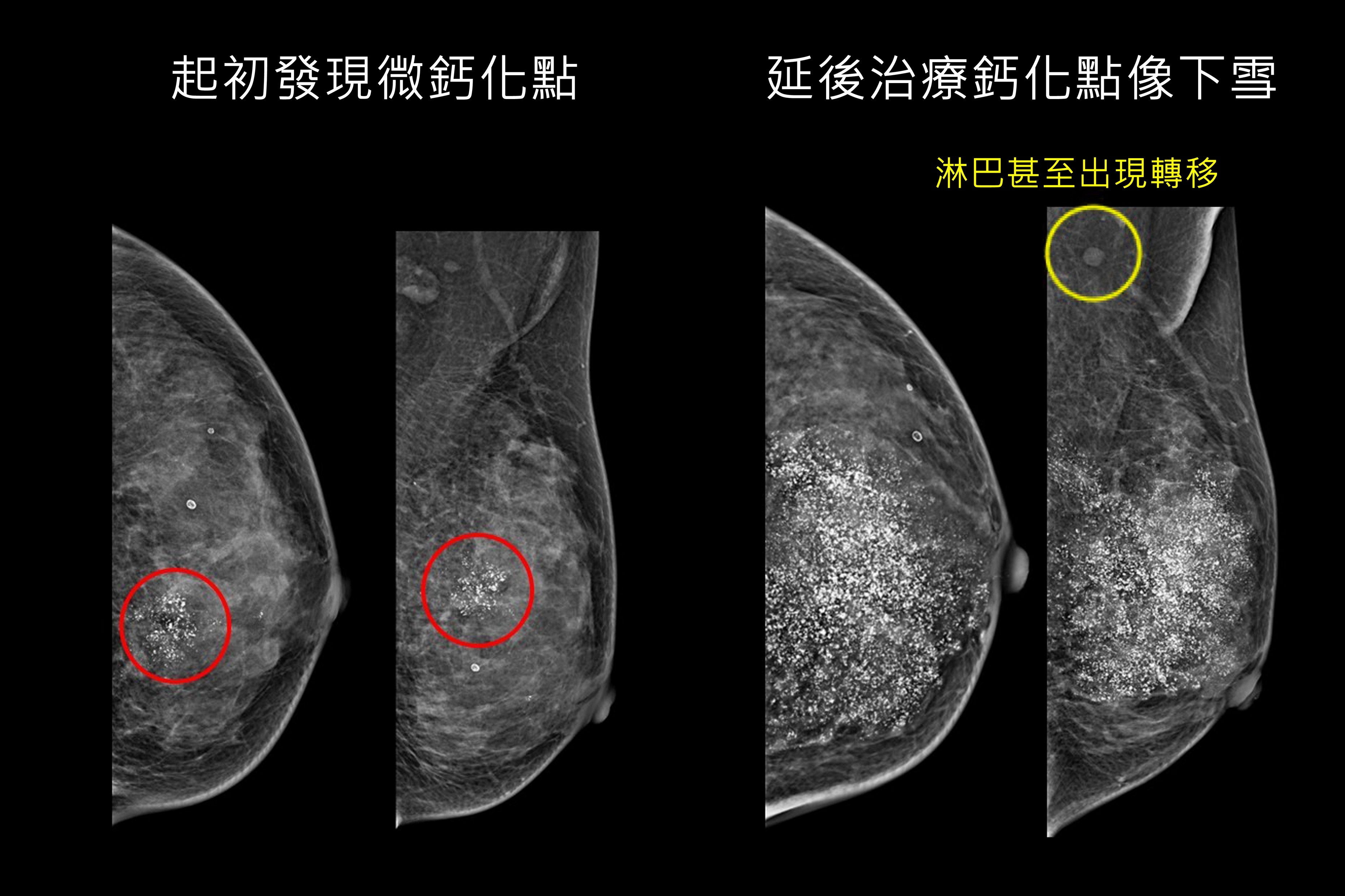 婦人接受乳房攝影篩檢發現微鈣化點，再切片確認罹患早期乳癌（左圖 ），延後治療再檢查，鈣化點如下雪並已出現淋巴轉移（右圖 ）