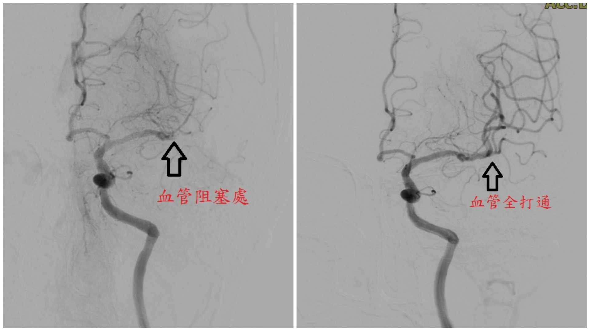 （左圖）取栓前（右圖）取栓後