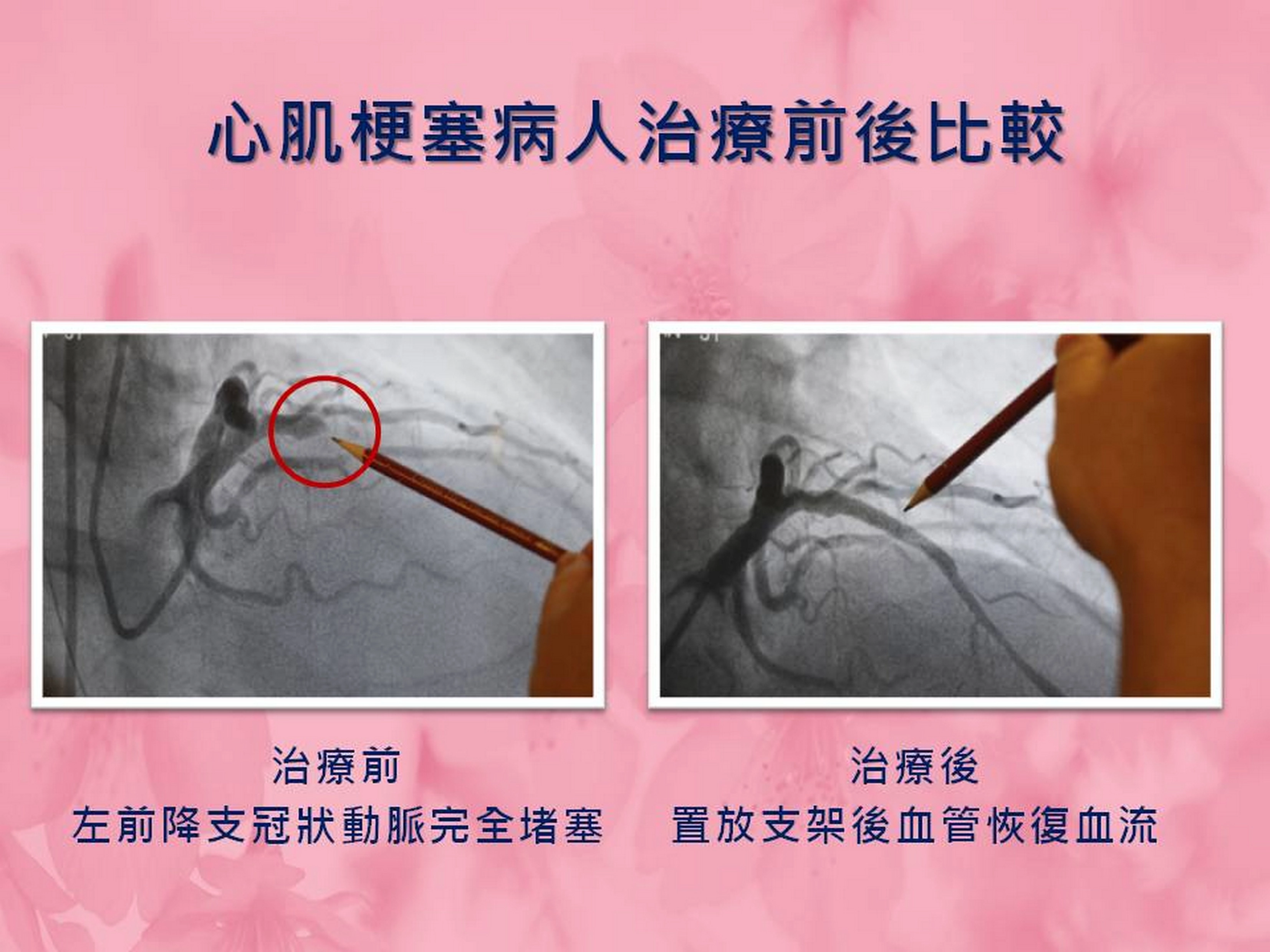 心梗肌塞病人治療前後比較。