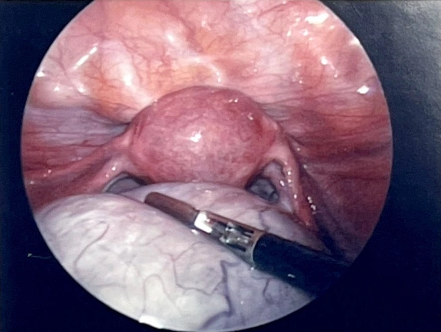 腹腔鏡手術切除卵巢巨大腫瘤。
