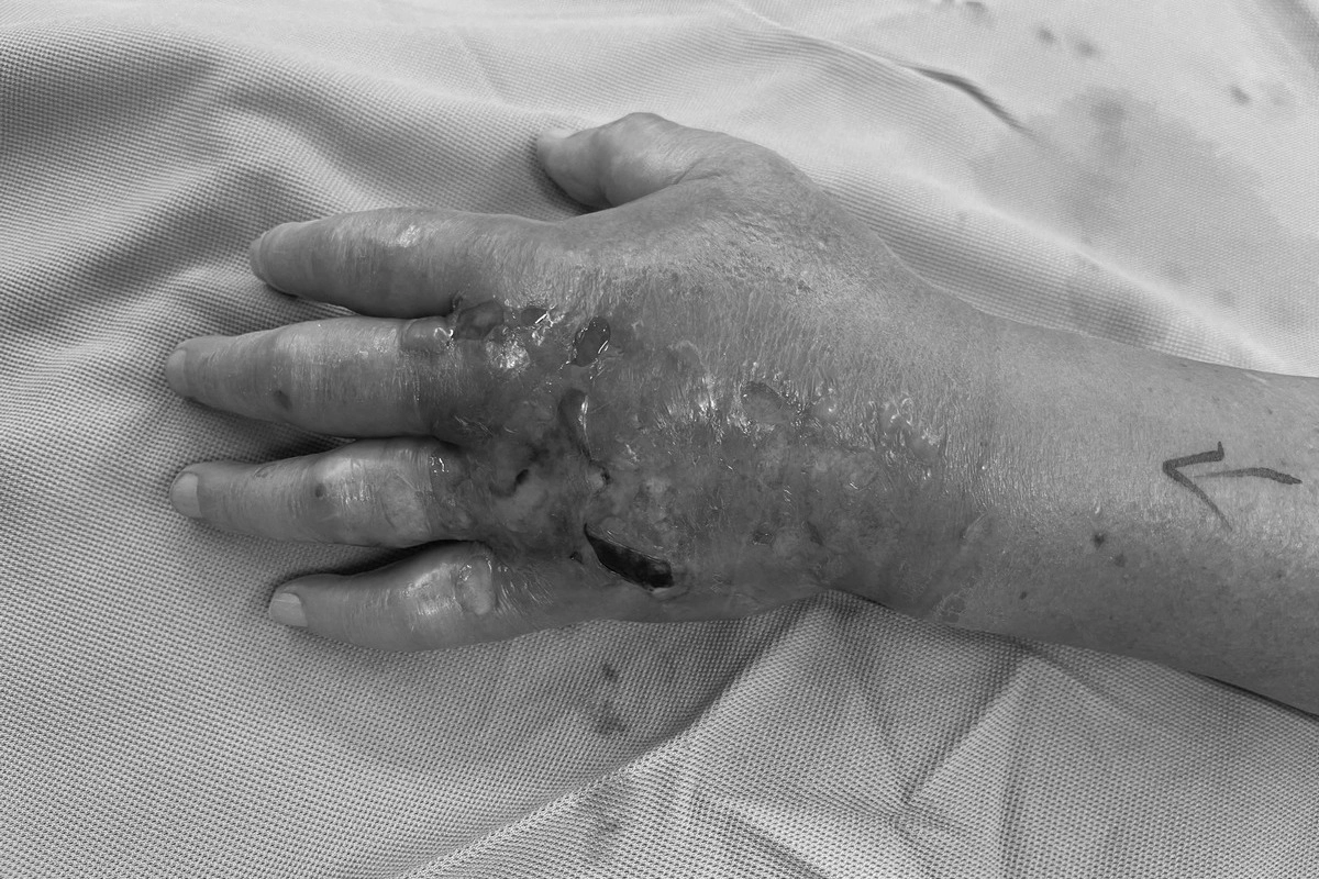 吳先生因被魚刺刺傷造成壞死筋膜炎，手掌呈現腫脹。
