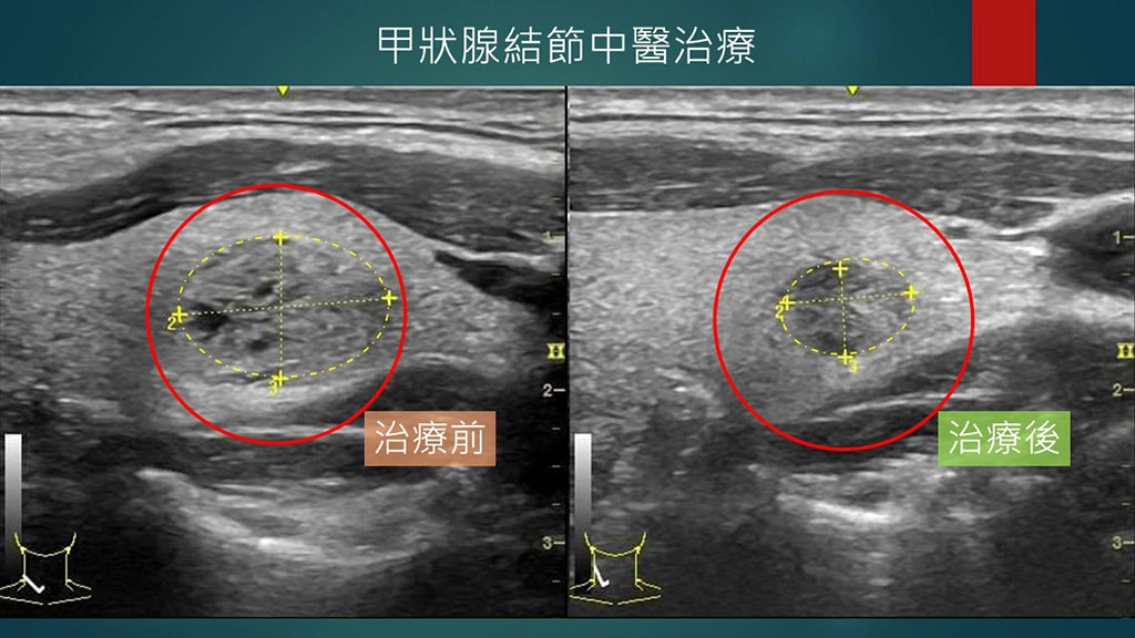 甲狀腺結節中醫治療前後超音波圖片。
