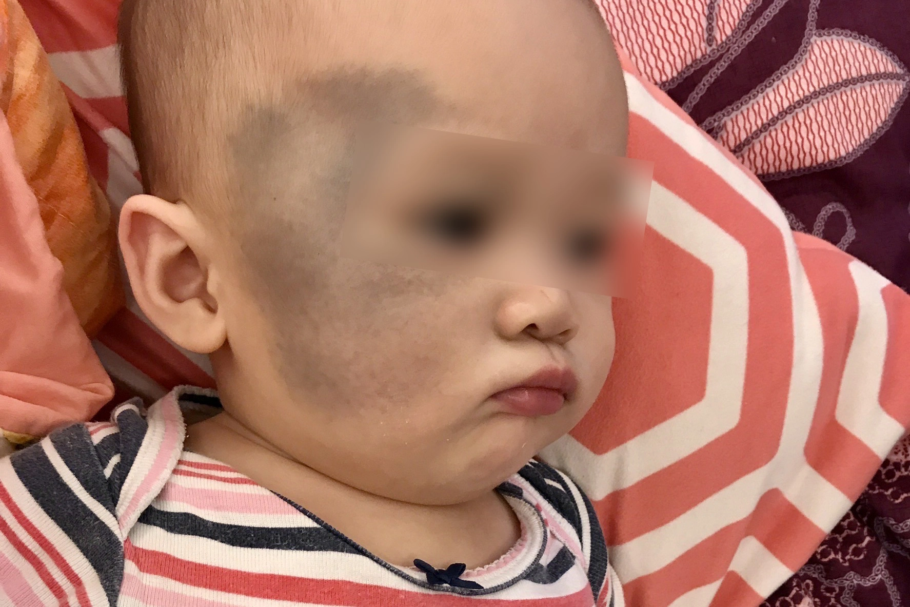 小霏出生臉上就有明顯太田母斑。