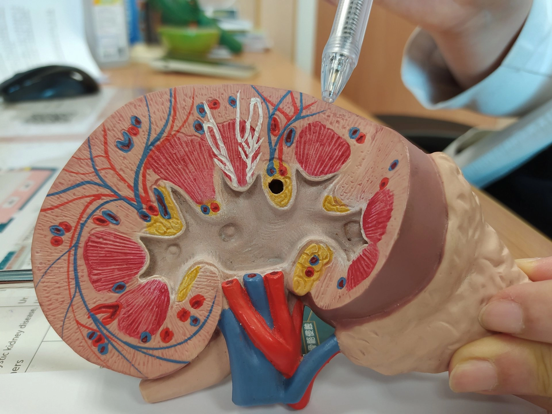 婦人經腎臟切片檢查，確認罹患紅斑性狼瘡性腎炎。