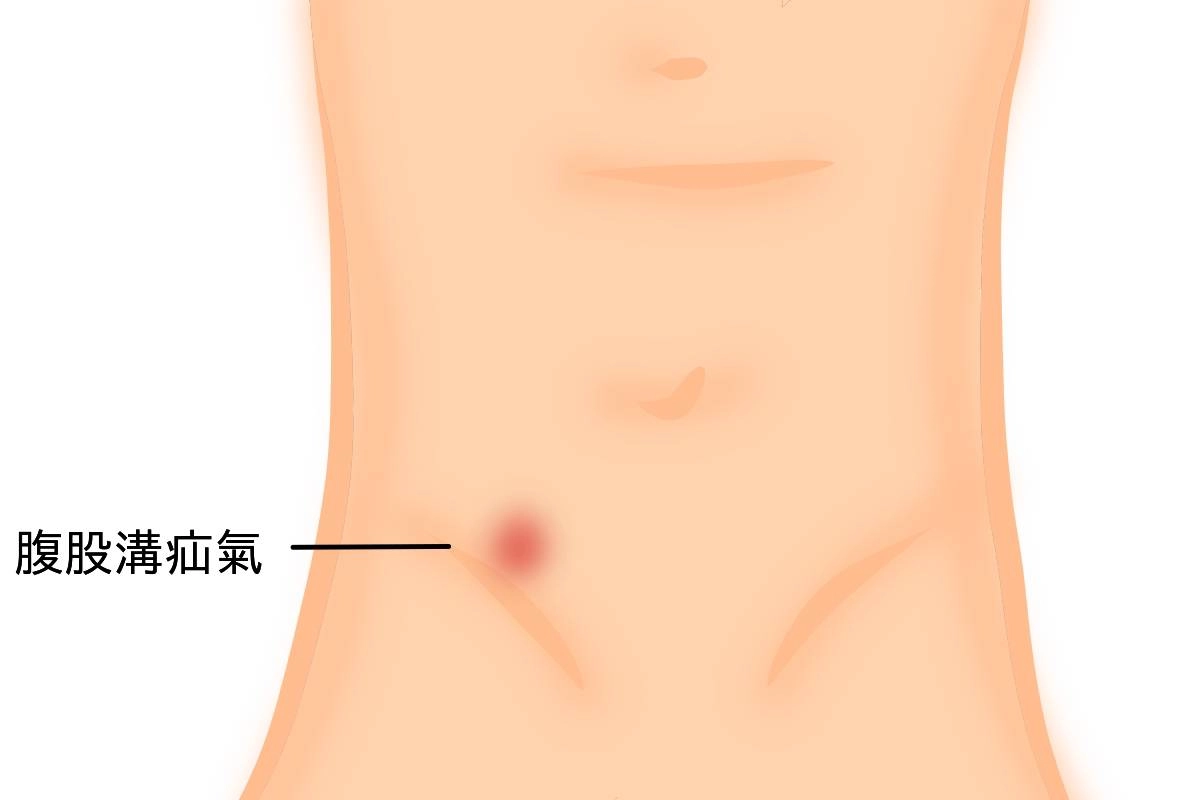 腹股溝疝氣示意照。