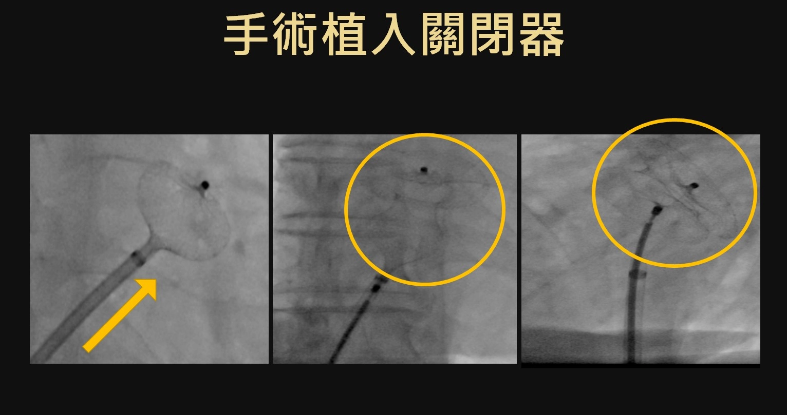 手術時將心房中膈缺損關閉器植入，在缺損的位置將關閉器展開，並將缺損修補。