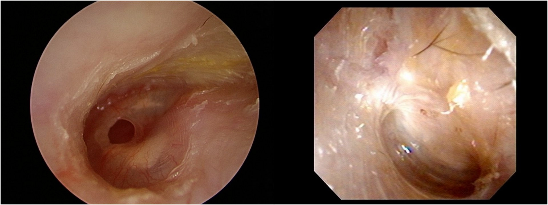 病人耳膜破損範圍占耳膜的15%，且經常出現分泌物、疼痛。內視鏡微創修補後三個月追蹤，耳膜已經順利增生修復。