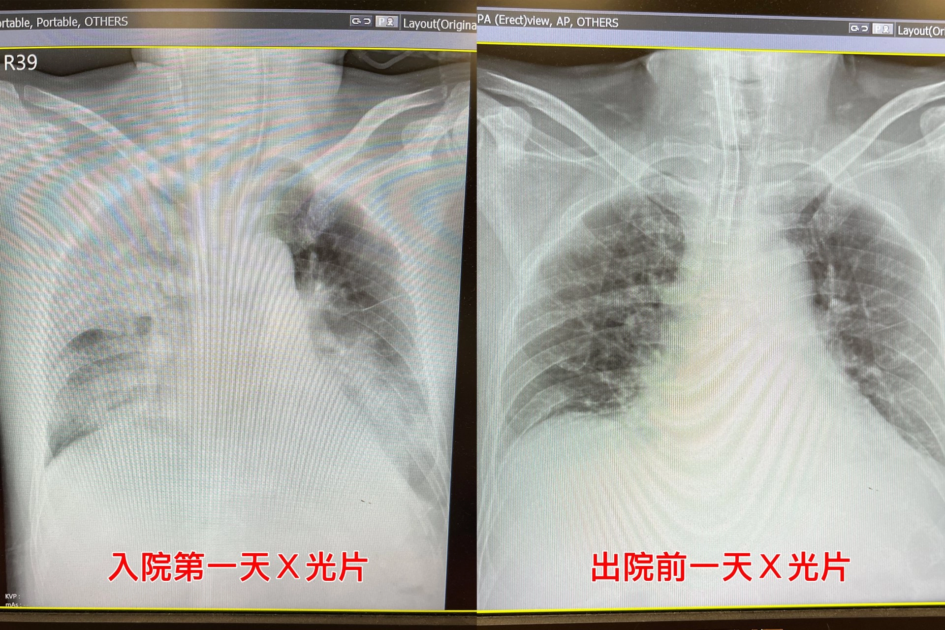 葉先生入院時與出院前的X光片。