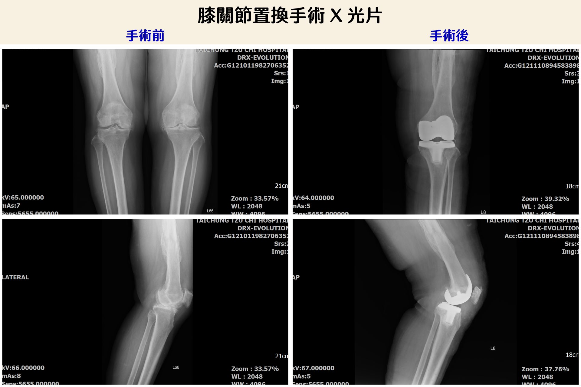 陳女士接受膝關節置換手術前後X光檢查影像。