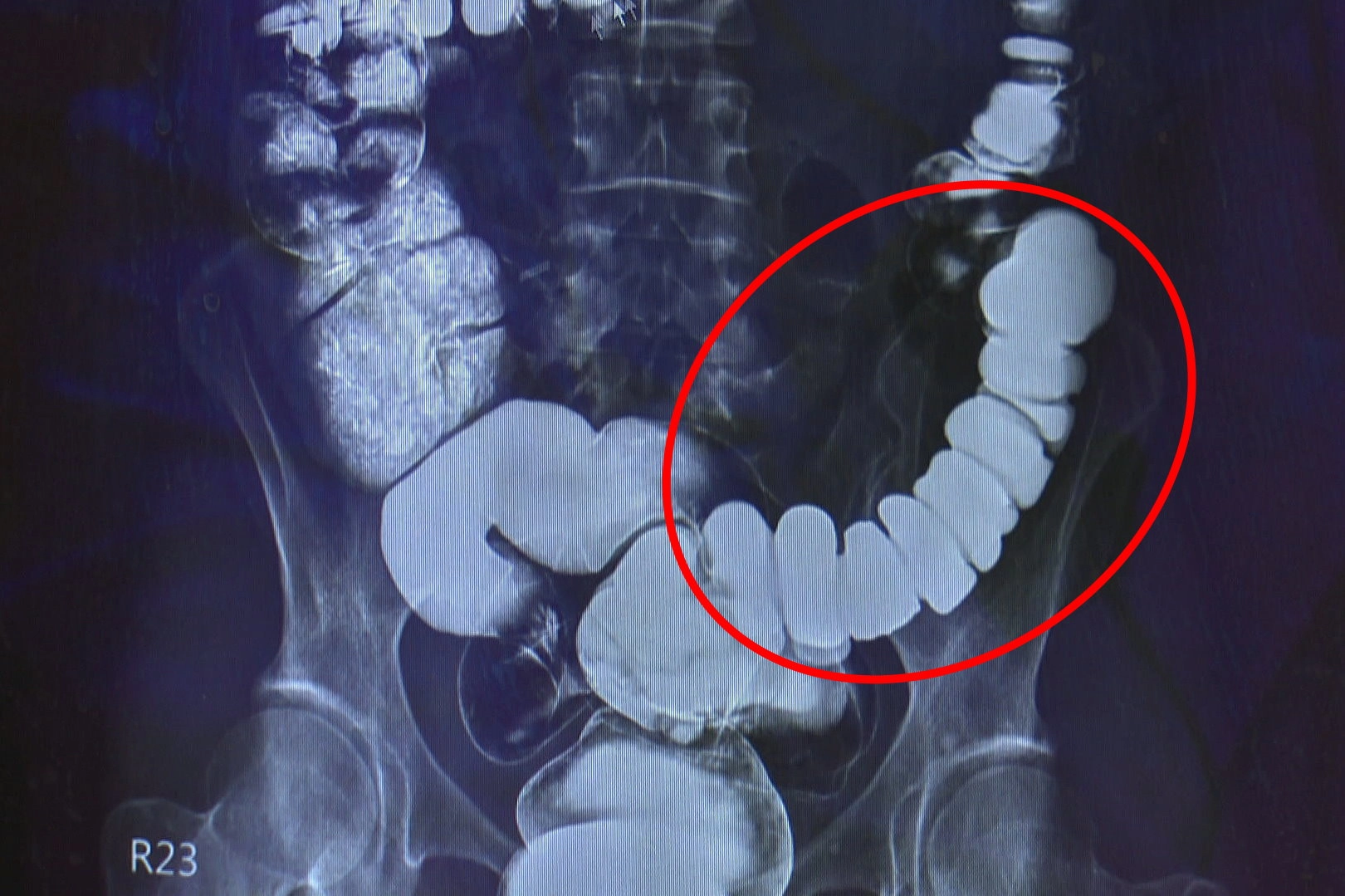 邱建銘主任從大腸攝影檢查發現，江小姐腸子繃得非常緊。