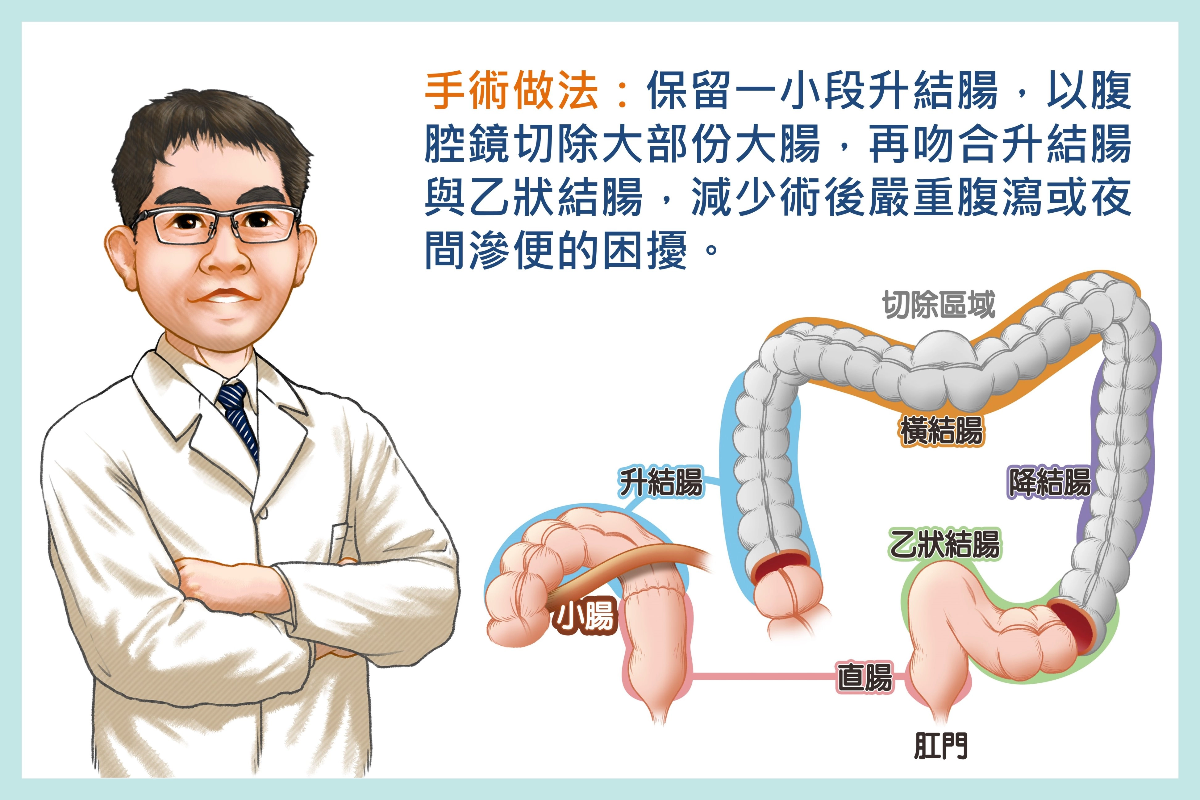 邱建銘主任保留病人一小段升結腸，切除大部份大腸，再吻合升結腸與乙狀結腸。