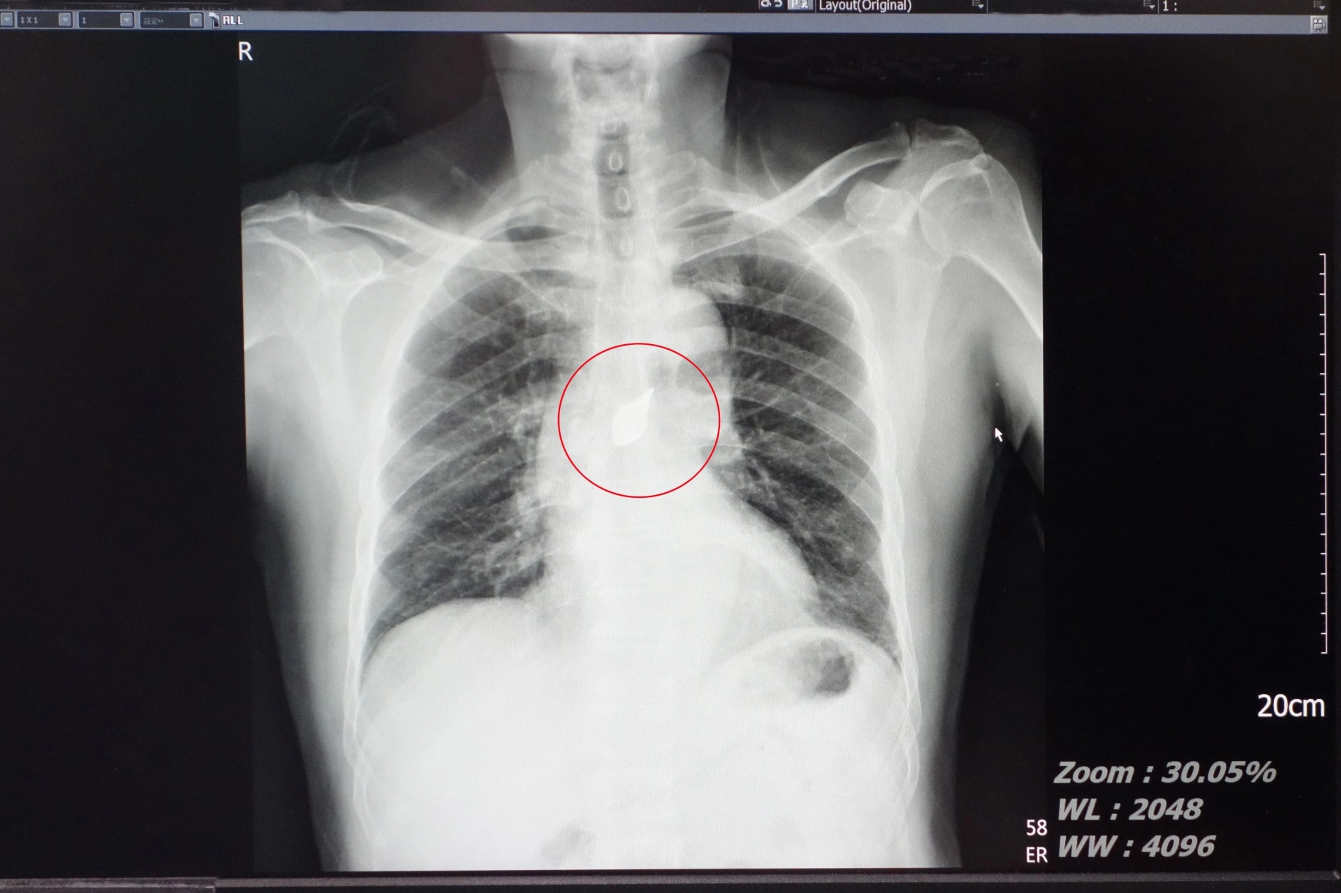 補充：病人左胸傷口，但是碎片在體內移動到中央偏右處。所以胸腔鏡是做右邊