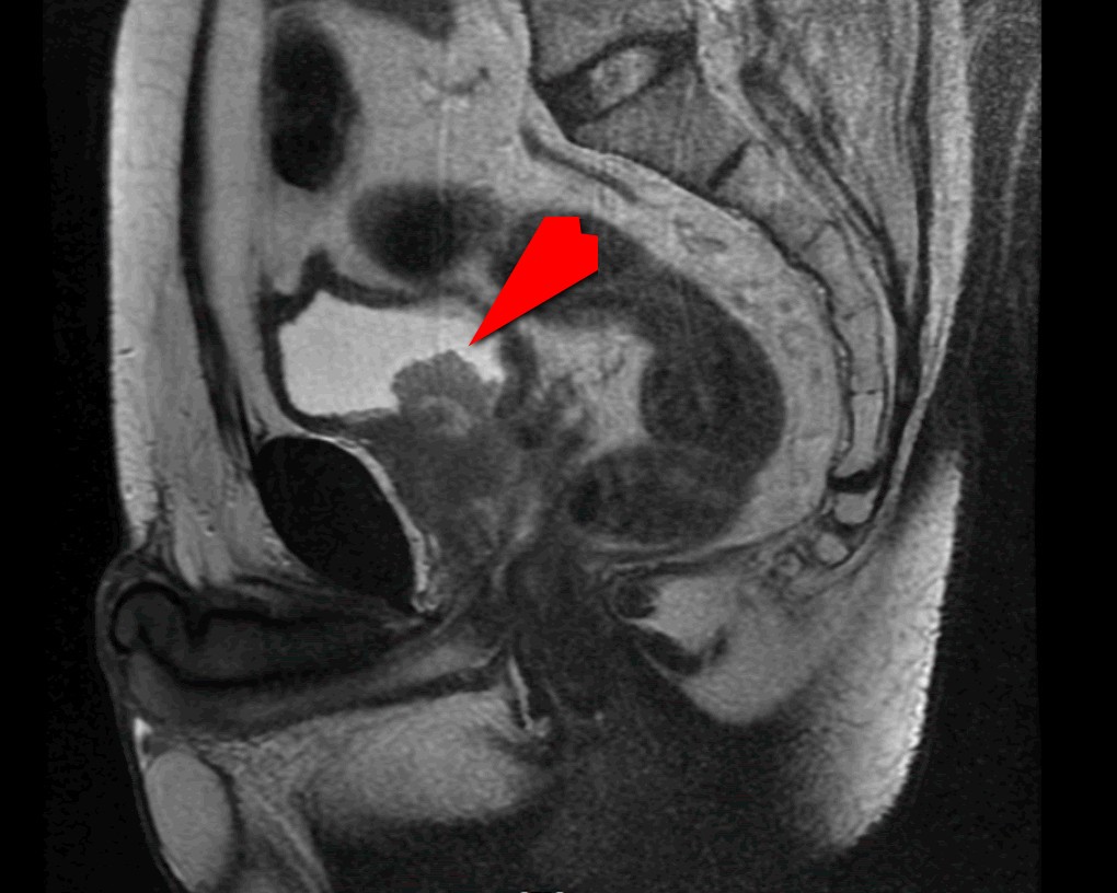 核磁共振影像中紅色箭頭所指，顯示病人攝護腺腫瘤已侵犯膀胱。