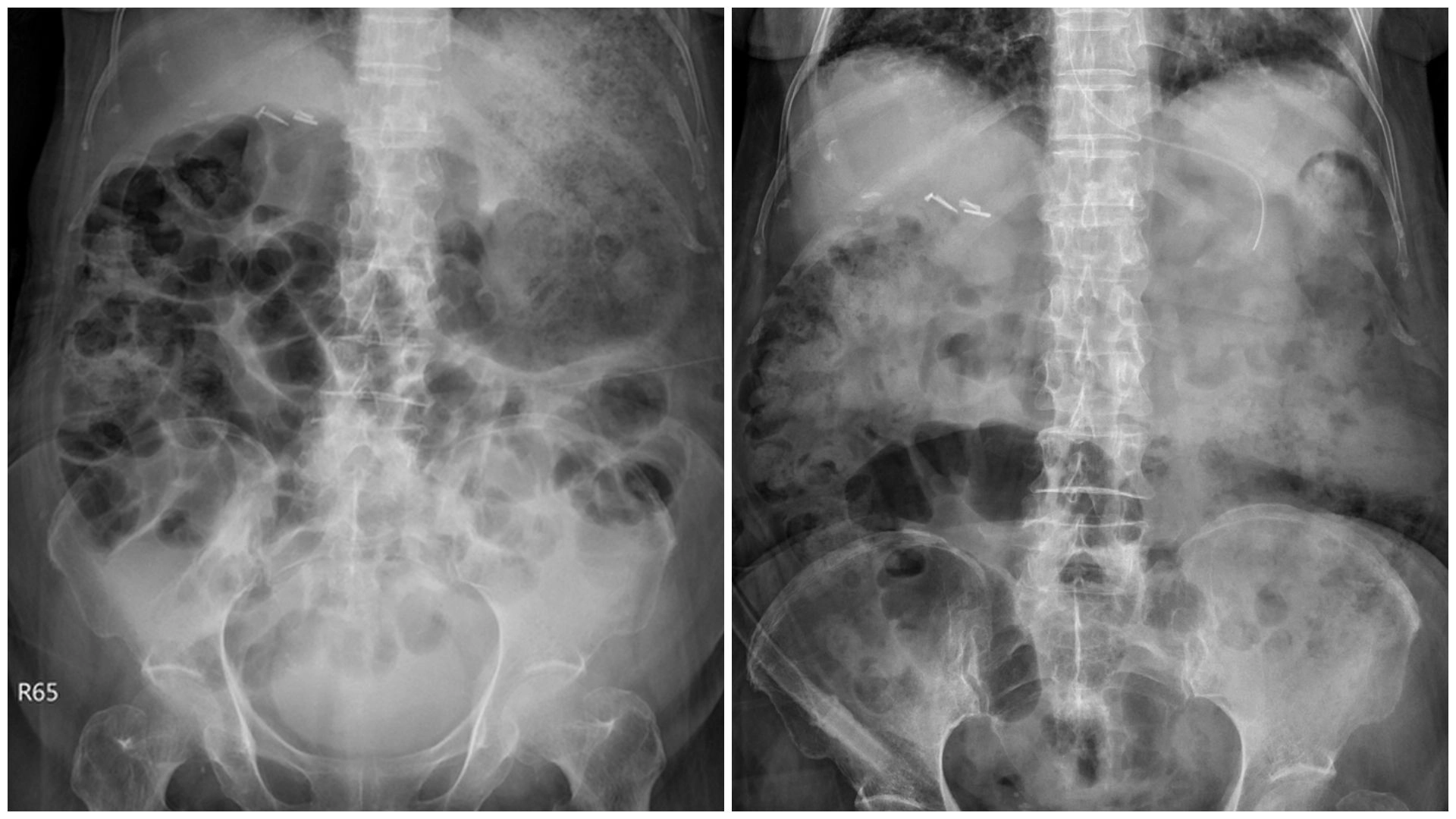 左圖為治療前，影像中黑色區塊為氣體鬱積於腸道，導致腸阻塞；右圖為治療後，鬱積處明顯消散。