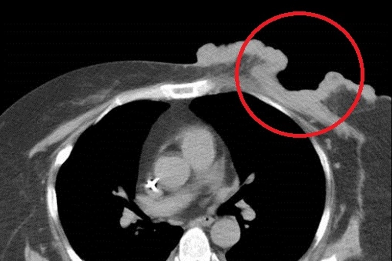 影像顯示腫瘤明顯侵襲胸壁，且造成開放性傷口。